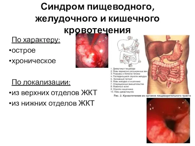 Синдром пищеводного, желудочного и кишечного кровотечения По характеру: острое хроническое По локализации: