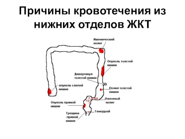 Причины кровотечения из нижних отделов ЖКТ