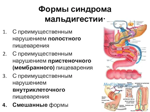 Формы синдрома мальдигестии: С преимущественным нарушением полостного пищеварения С преимущественным нарушением пристеночного