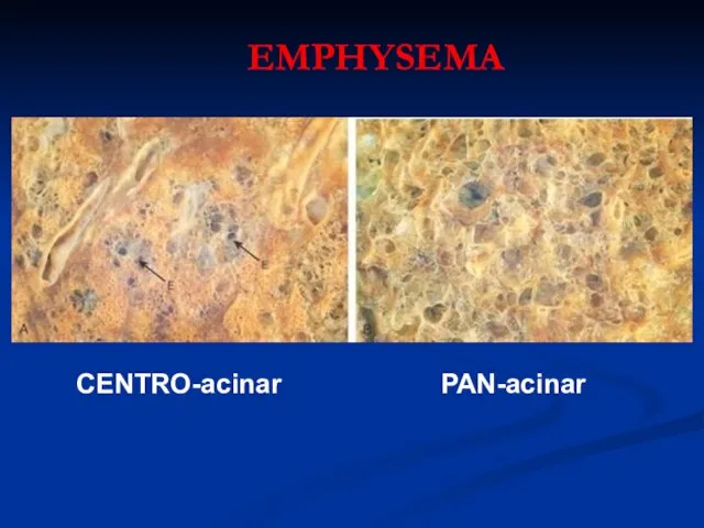 CENTRO-acinar PAN-acinar EMPHYSEMA