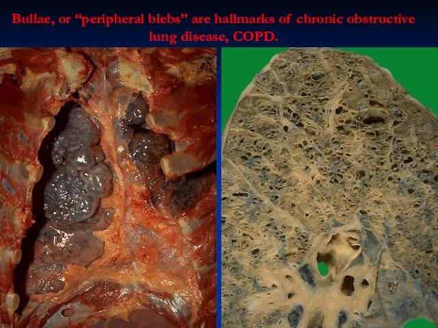 Bullae, or “peripheral blebs” are hallmarks of chronic obstructive lung disease, COPD.