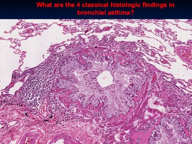 What are the 4 classical histologic findings in bronchial asthma?