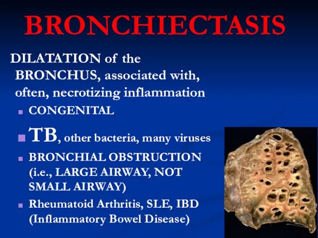 BRONCHIECTASIS DILATATION of the BRONCHUS, associated with, often, necrotizing inflammation CONGENITAL TB,