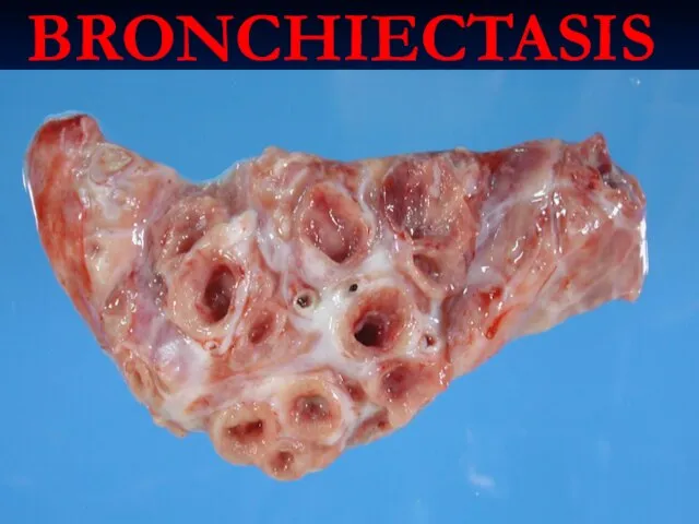 BRONCHIECTASIS