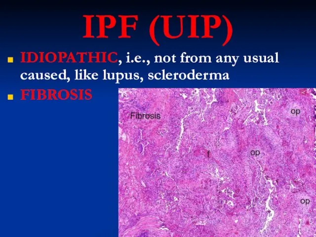 IPF (UIP) IDIOPATHIC, i.e., not from any usual caused, like lupus, scleroderma FIBROSIS