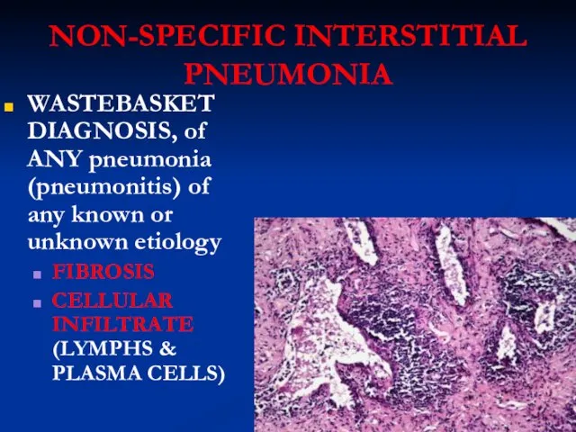 NON-SPECIFIC INTERSTITIAL PNEUMONIA WASTEBASKET DIAGNOSIS, of ANY pneumonia (pneumonitis) of any known