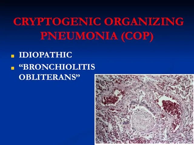 CRYPTOGENIC ORGANIZING PNEUMONIA (COP) IDIOPATHIC “BRONCHIOLITIS OBLITERANS”