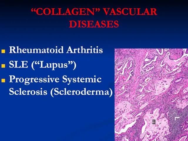 “COLLAGEN” VASCULAR DISEASES Rheumatoid Arthritis SLE (“Lupus”) Progressive Systemic Sclerosis (Scleroderma)