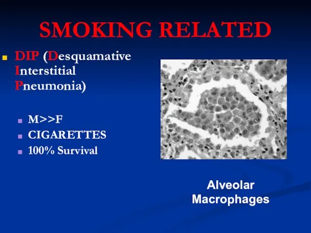 SMOKING RELATED DIP (Desquamative Interstitial Pneumonia) M>>F CIGARETTES 100% Survival Alveolar Macrophages