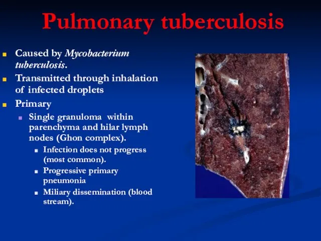 Pulmonary tuberculosis Caused by Mycobacterium tuberculosis. Transmitted through inhalation of infected droplets