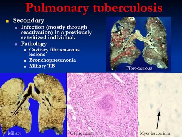 Pulmonary tuberculosis Secondary Infection (mostly through reactivation) in a previously sensitized individual.