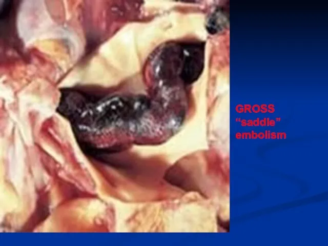 GROSS “saddle” embolism