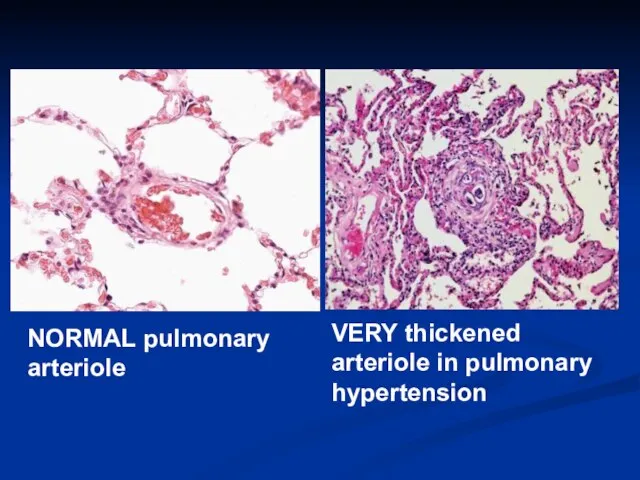 VERY thickened arteriole in pulmonary hypertension NORMAL pulmonary arteriole