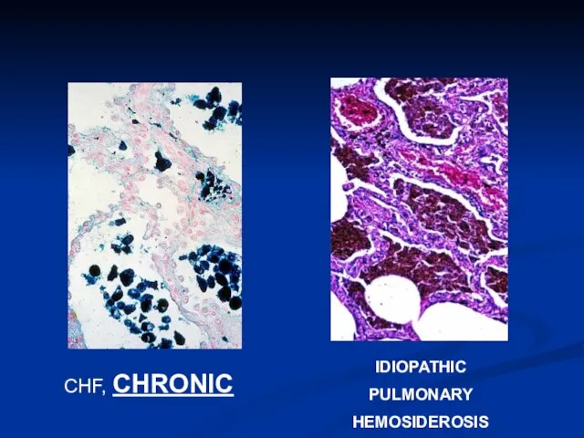 CHF, CHRONIC IDIOPATHIC PULMONARY HEMOSIDEROSIS