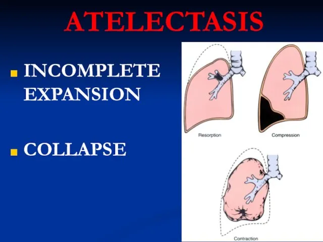 ATELECTASIS INCOMPLETE EXPANSION COLLAPSE