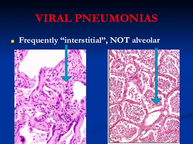 VIRAL PNEUMONIAS Frequently “interstitial”, NOT alveolar