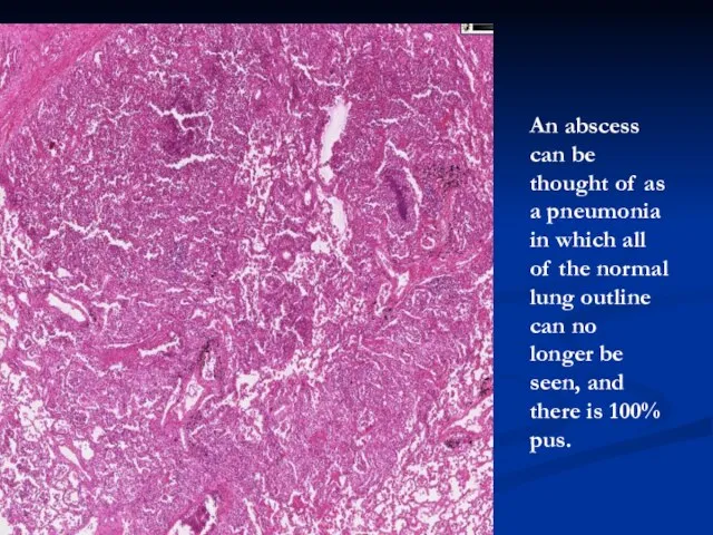 An abscess can be thought of as a pneumonia in which all