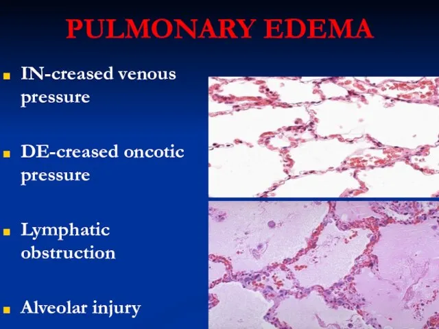 PULMONARY EDEMA IN-creased venous pressure DE-creased oncotic pressure Lymphatic obstruction Alveolar injury