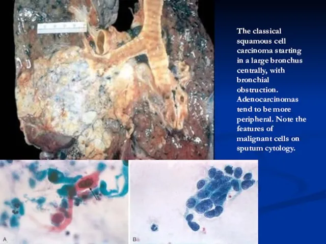 The classical squamous cell carcinoma starting in a large bronchus centrally, with