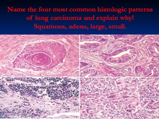 Name the four most common histologic patterns of lung carcinoma and explain