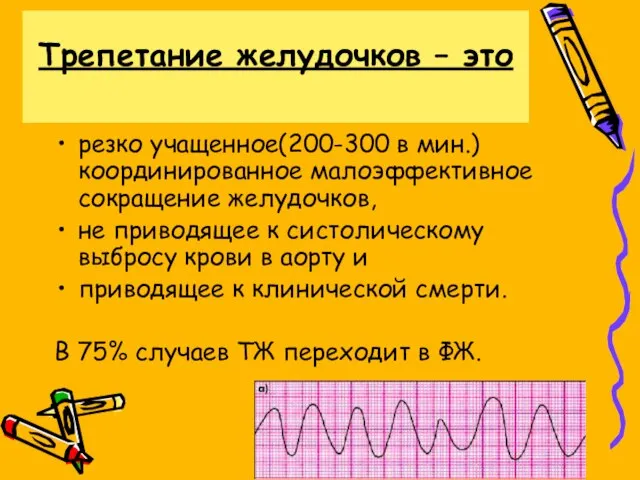 Трепетание желудочков – это резко учащенное(200-300 в мин.) координированное малоэффективное сокращение желудочков,