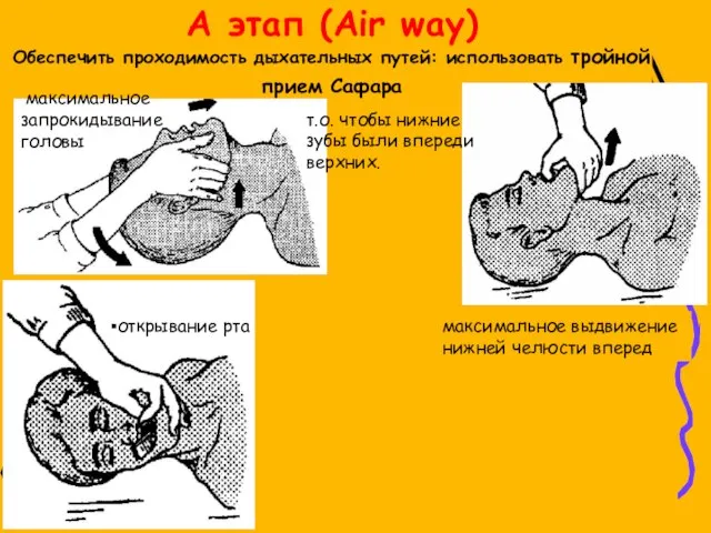 A этап (Air way) Обеспечить проходимость дыхательных путей: использовать тройной прием Сафара