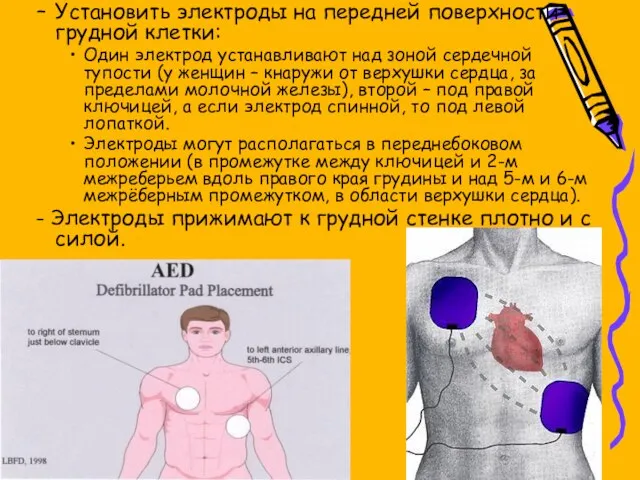 Установить электроды на передней поверхности грудной клетки: Один электрод устанавливают над зоной