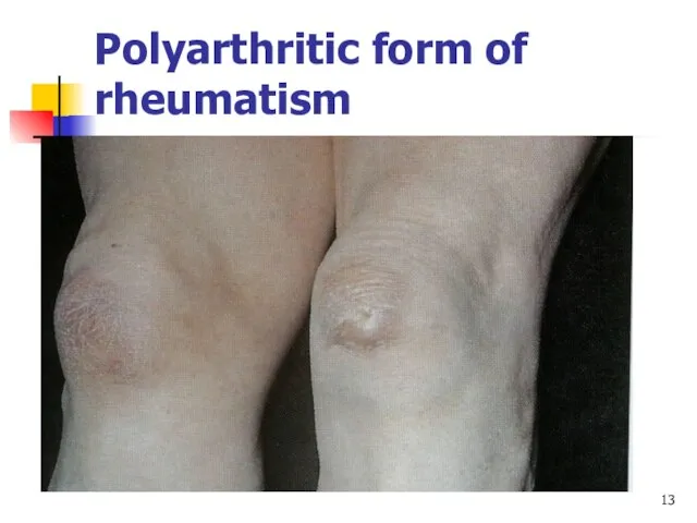 Polyarthritic form of rheumatism