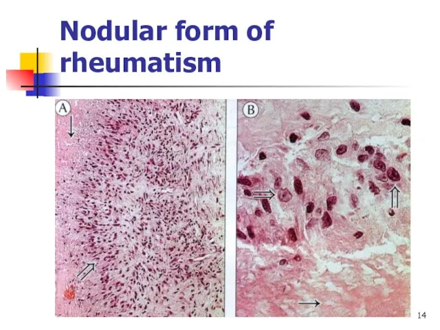 Nodular form of rheumatism