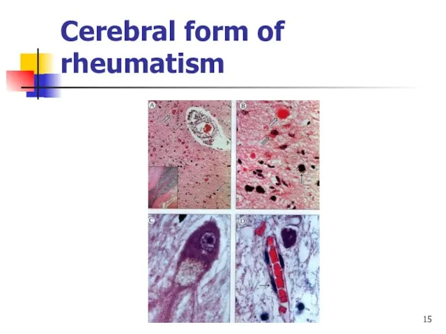 Cerebral form of rheumatism