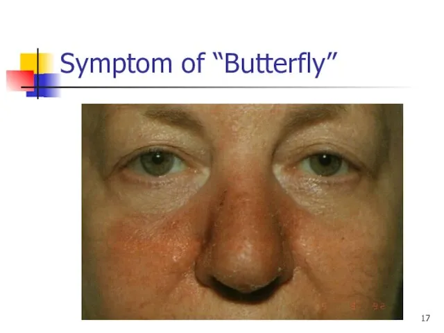 Symptom of “Butterfly”