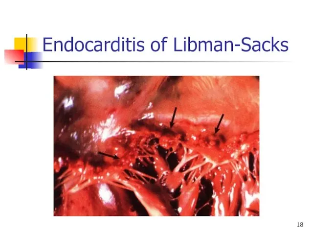 Endocarditis of Libman-Sacks