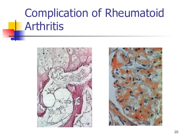 Complication of Rheumatoid Arthritis