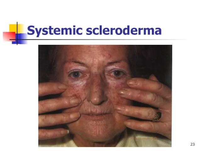 Systemic scleroderma