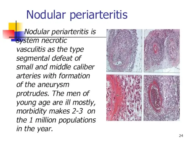 Nodular periarteritis Nodular periarteritis is system necrotic vasculitis as the type segmental