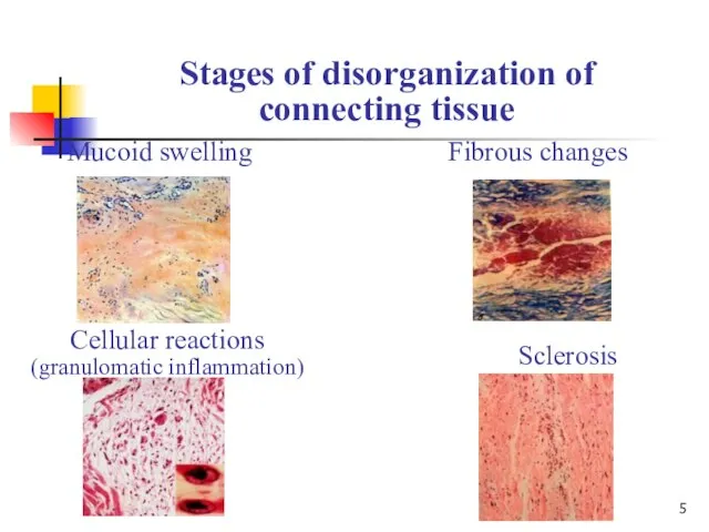 Mucoid swelling Stages of disorganization of connecting tissue Fibrous changes Cellular reactions (granulomatic inflammation) Sclerosis