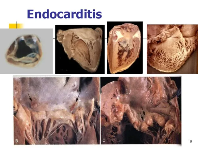 Endocarditis