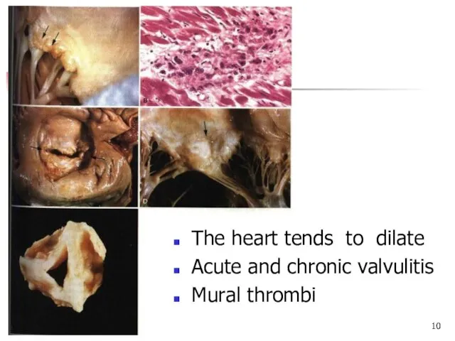 The heart tends to dilate Acute and chronic valvulitis Mural thrombi