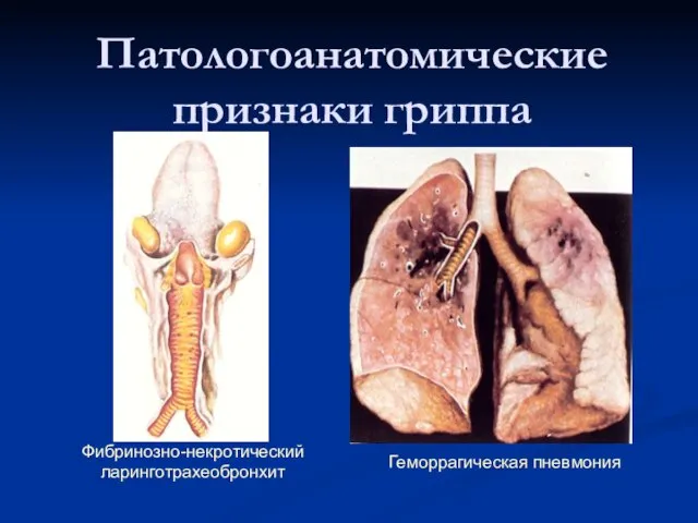 Патологоанатомические признаки гриппа Фибринозно-некротический ларинготрахеобронхит Геморрагическая пневмония