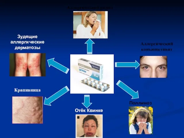 Аллергический конъюнктивит Зудящие аллергические дерматозы Крапивница Аллергический ринит Поллиноз Отёк Квинке