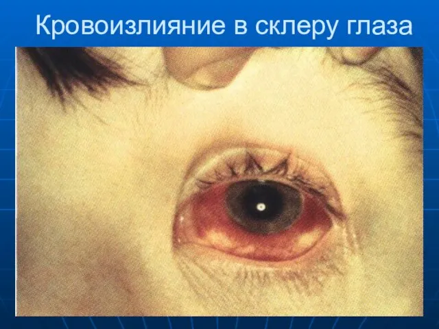 Кровоизлияние в склеру глаза