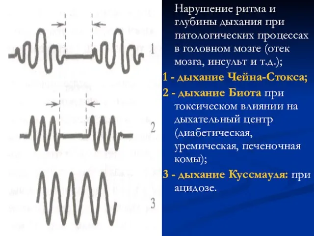 Нарушение ритма и глубины дыхания при патологических процессах в го­ловном мозге (отек