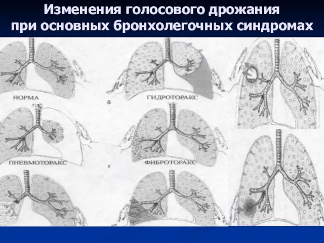 Изменения голосового дрожания при основных бронхолегочных синдромах Обтурационный ателектаз Долевое уплотнение Очаговое уплотнение