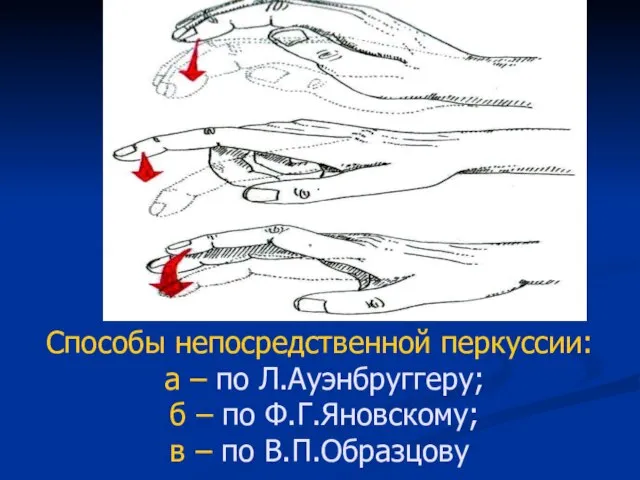 Способы непосредственной перкуссии: а – по Л.Ауэнбруггеру; б – по Ф.Г.Яновскому; в – по В.П.Образцову