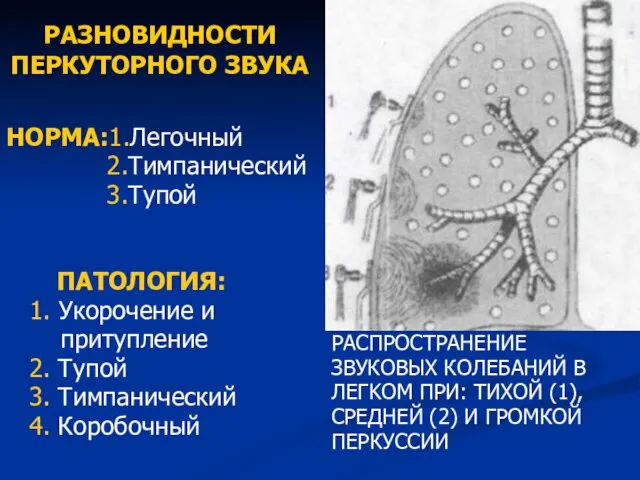 РАЗНОВИДНОСТИ ПЕРКУТОРНОГО ЗВУКА НОРМА:1.Легочный 2.Тимпанический 3.Тупой ПАТОЛОГИЯ: 1. Укорочение и притупление 2.