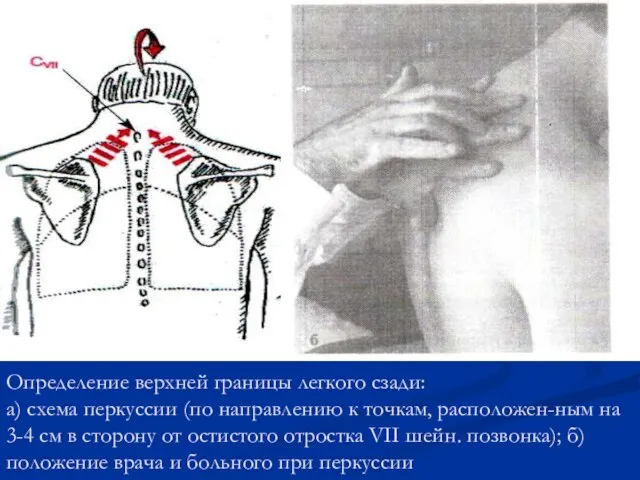 Определение верхней границы легкого сзади: а) схема перкуссии (по направлению к точкам,