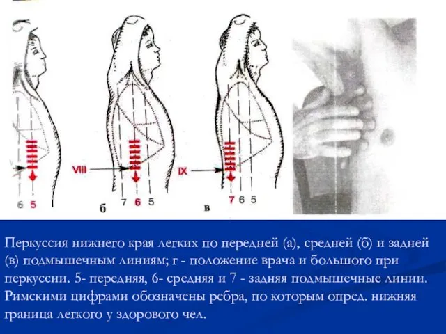 Перкуссия нижнего края легких по передней (а), средней (б) и задней (в)