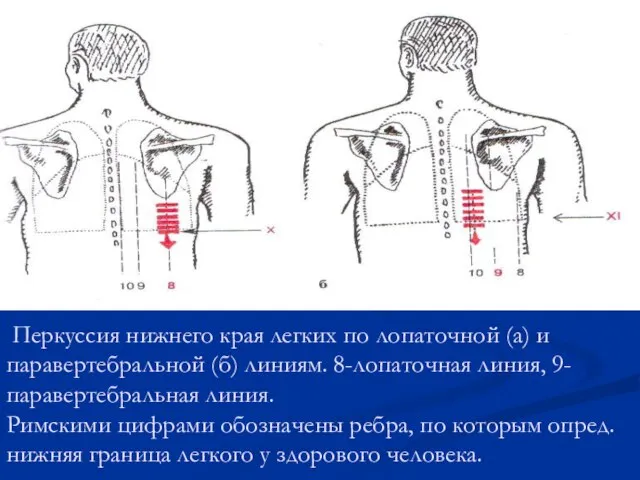 Перкуссия нижнего края легких по лопаточной (а) и паравертебральной (б) линиям. 8-лопаточная