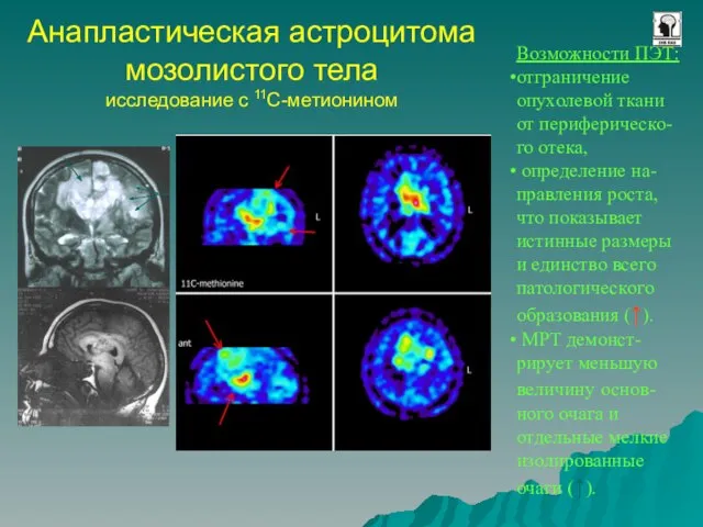 Анапластическая астроцитома мозолистого тела исследование с 11С-метионином Возможности ПЭТ: отграничение опухолевой ткани