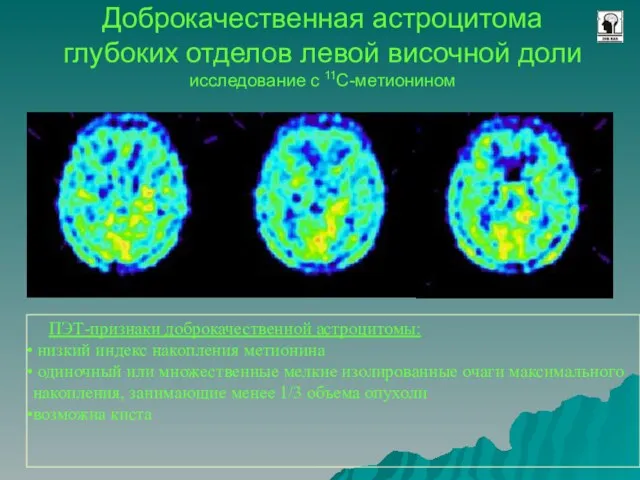 Доброкачественная астроцитома глубоких отделов левой височной доли исследование с 11C-метионином ПЭТ-признаки доброкачественной